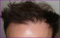 After 2nd hair restoration